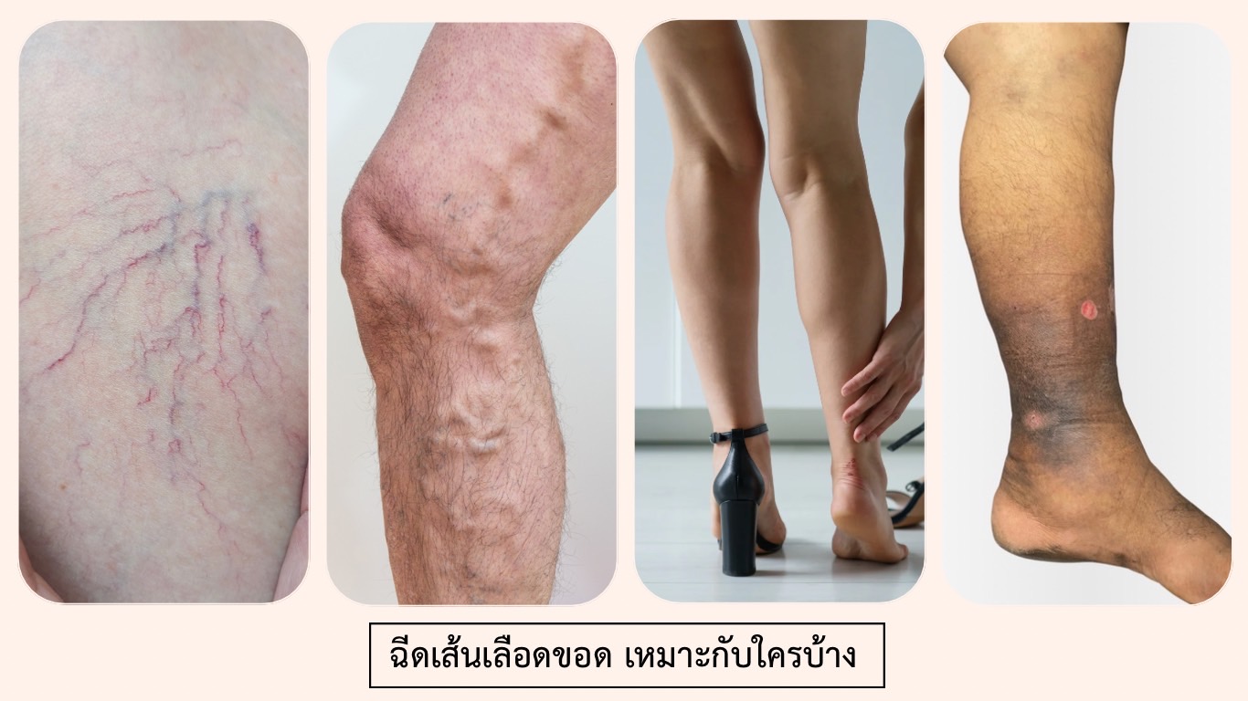 ฉีดเส้นเลือดขอด เหมาะกับใครบ้าง
