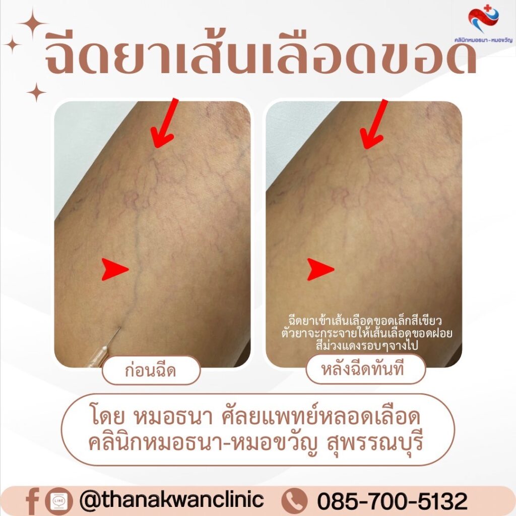 รีวิว ฉีดสลายเส้นเลือดขอด คลินิกหมอธนา