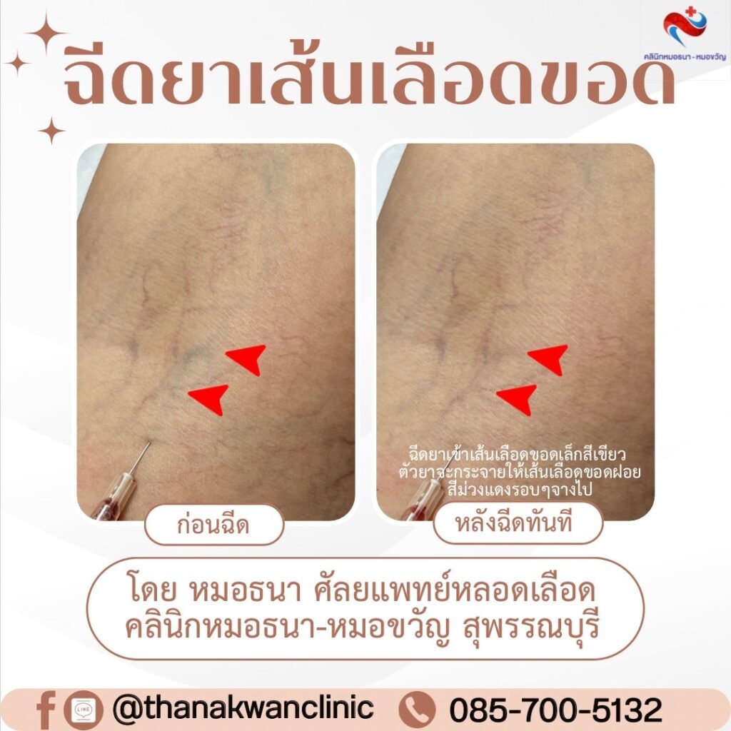 รีวิว ฉีดสลายเส้นเลือดขอด คลินิกหมอธนา
