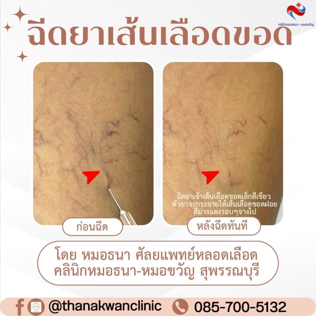 รีวิว ฉีดสลายเส้นเลือดขอด โดยศัลยแพทย์หลอดเลือด