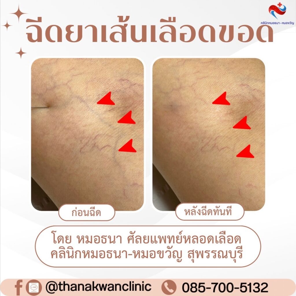 รีวิว ฉีดสลายเส้นเลือดขอด โดยศัลยแพทย์หลอดเลือด