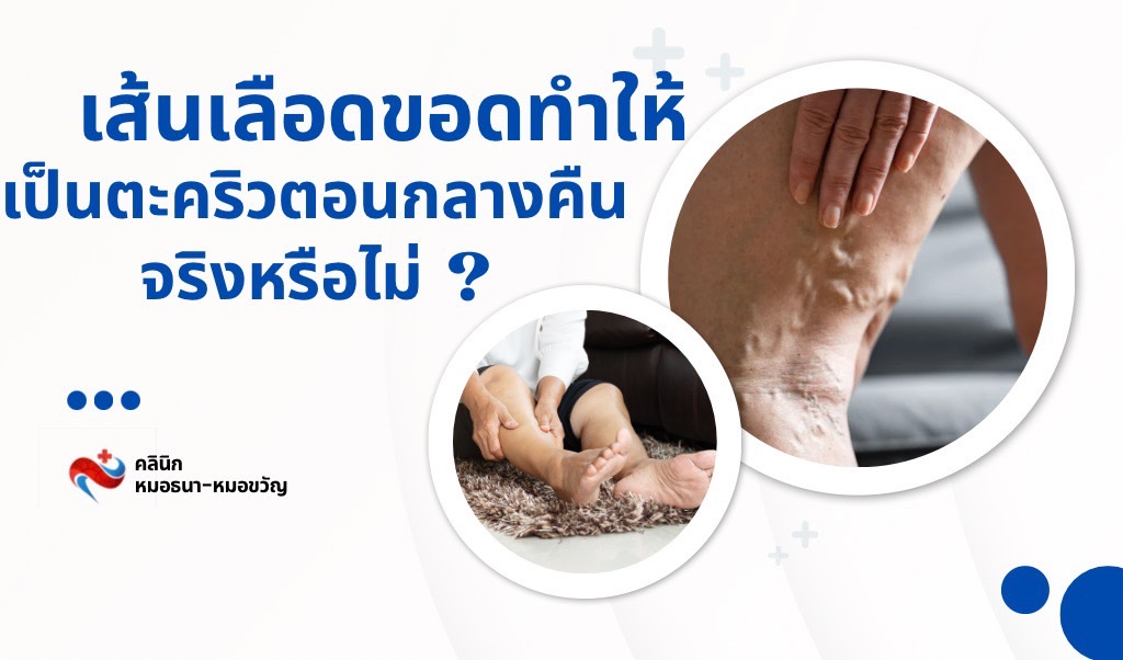 เป็นตะคริวตอนกลางคืน เกี่ยวกับเส้นเลือดขอดไหม