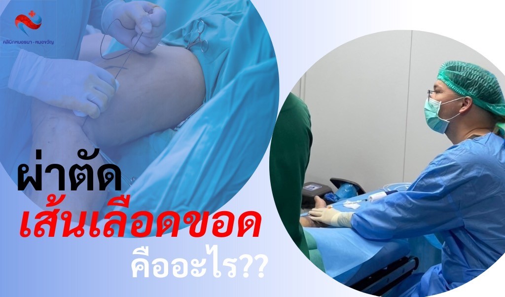 การผ่าตัดเส้นเลือดขอด คืออะไร