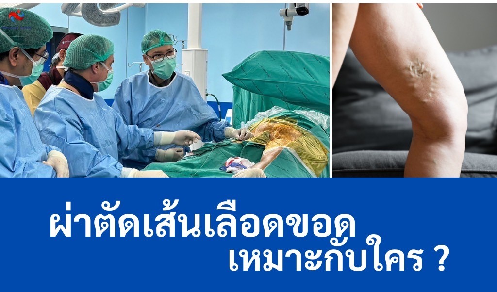 การผ่าตัดเส้นเลือดขอด เหมาะกับใคร