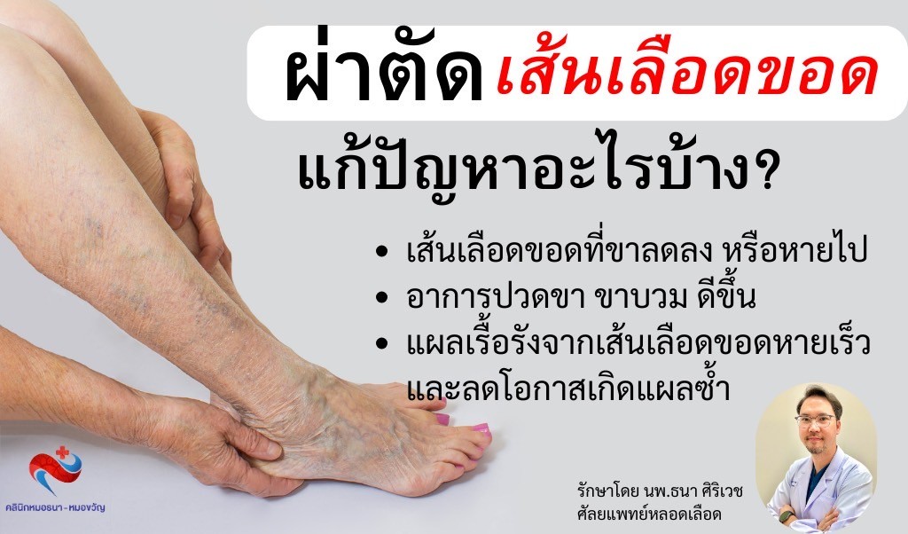 ผ่าตัดเส้นเลือดขอด ช่วยเรื่องอะไรบ้าง