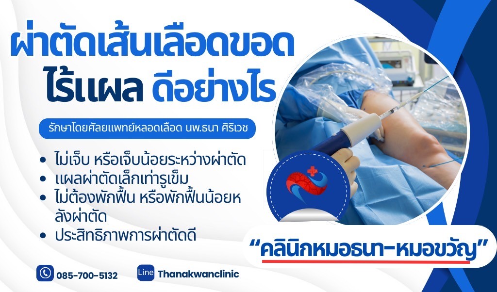 ผ่าตัดเส้นเลือดขอด แบบไร้แผล เหมาะกับใคร
