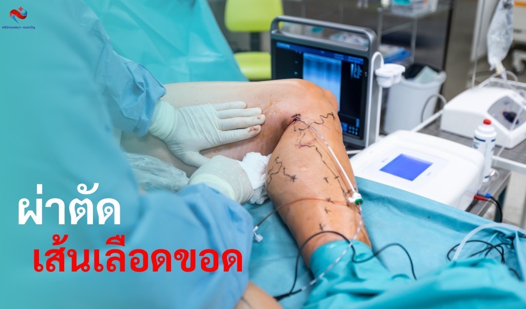 ผ่าตัดเส้นเลือดขอด