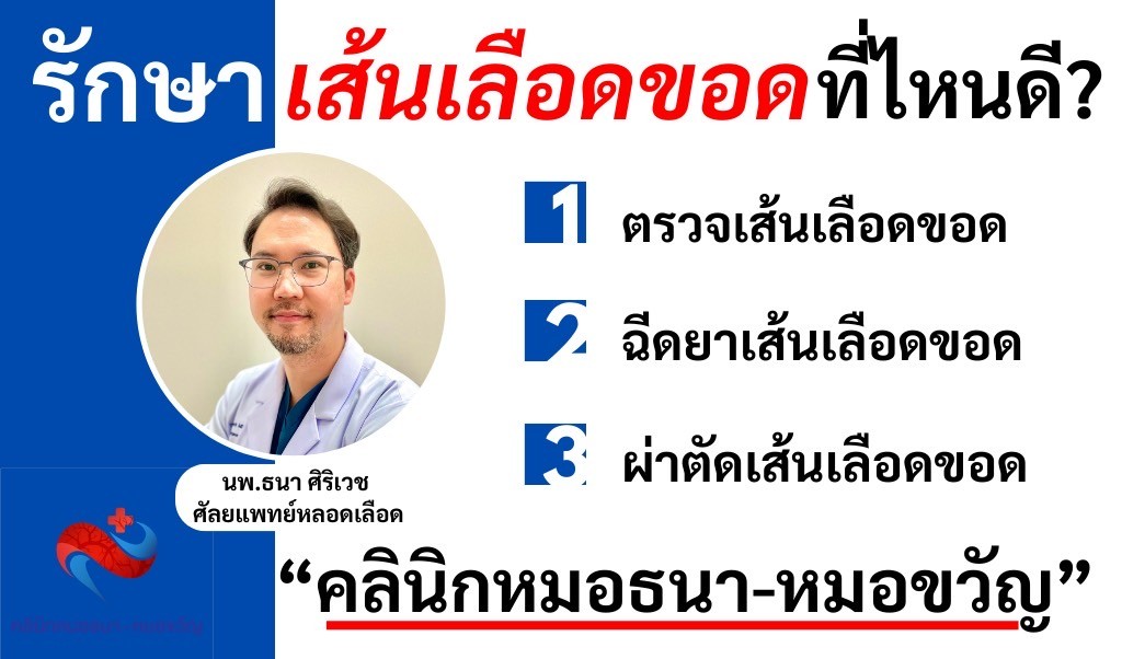 รักษาเส้นเลือดขอด ที่ไหนดี