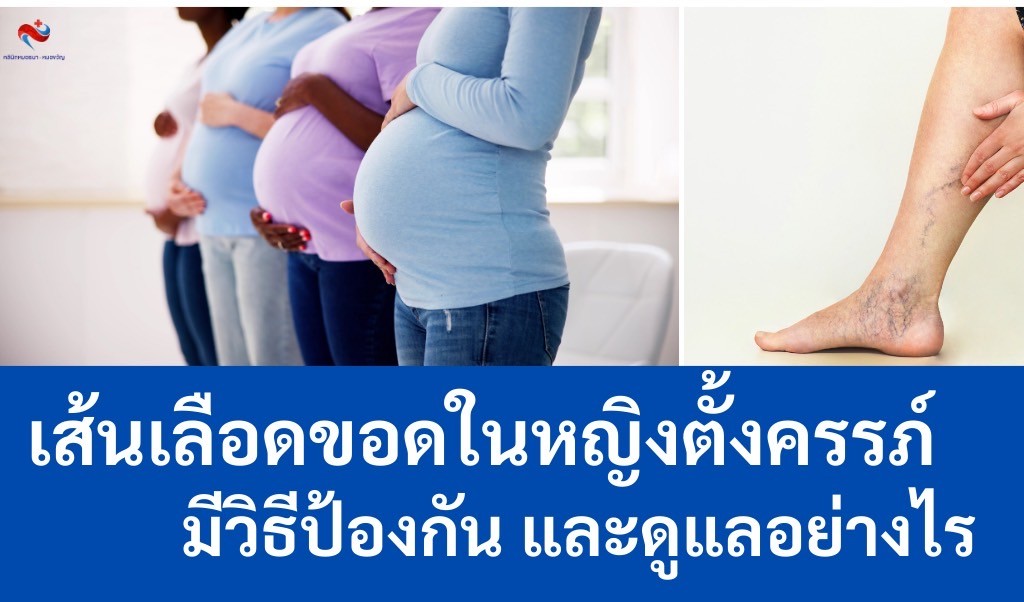 เส้นเลือดขอดในผู้หญิงตั้งครรภ์