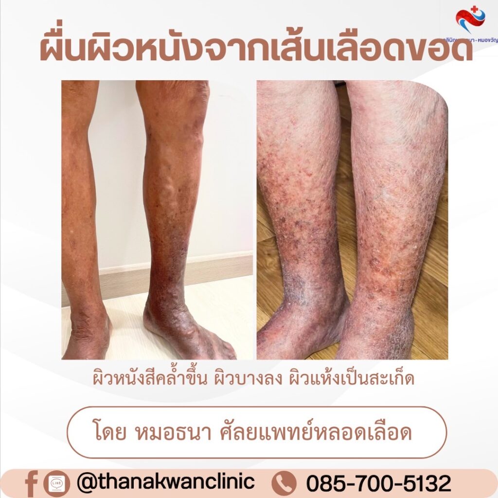 ผื่นผิวหนังจากเส้นเลือดขอด