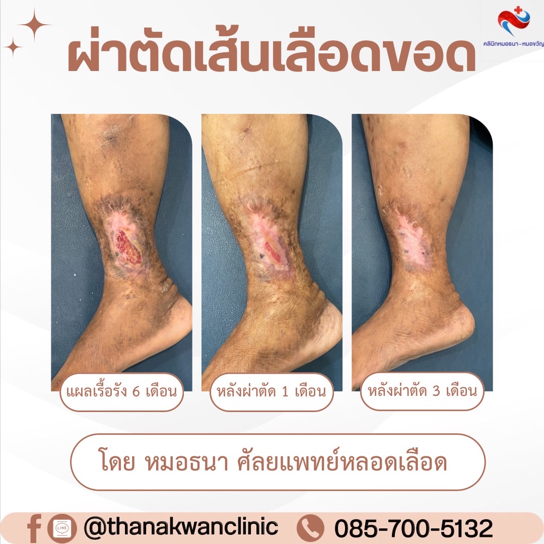ผ่าตัดเส้นเลือดขอด แผลเรื้อรังข้อเท้า
