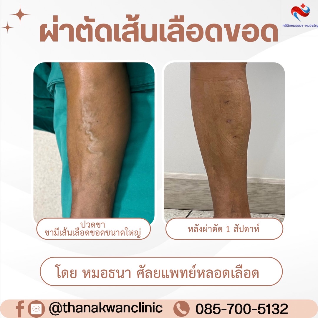 รักษาด้วยการผ่าตัดเส้นเลือดขอด
