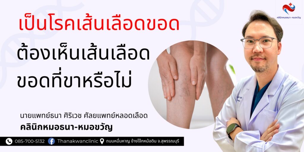 เป็นโรคเส้นเลือดขอดจำเป็นต้องมีเส้นเลือดขอดที่ขา