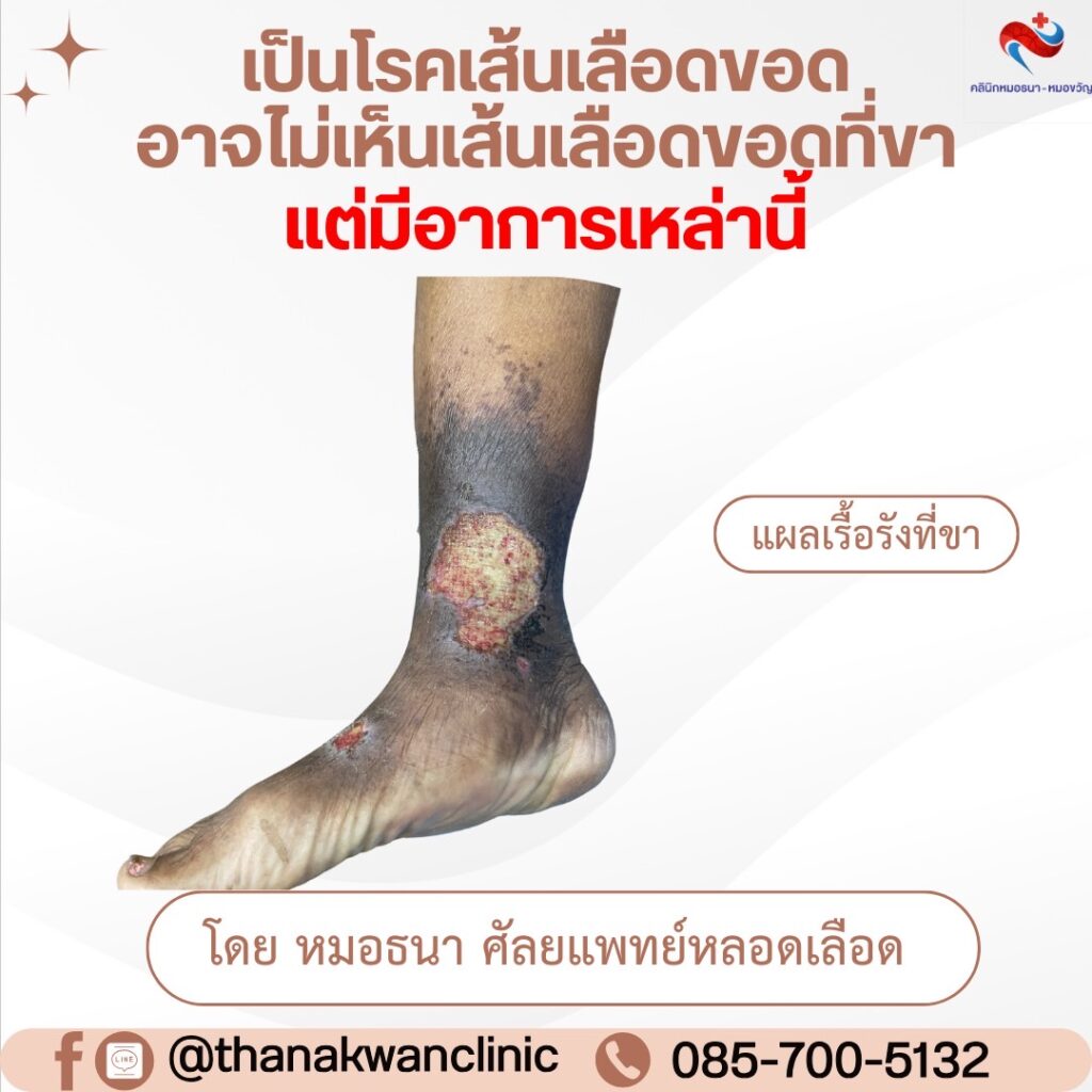 แผลจากโรคเส้นเลือดขอด แต่ไม่สังเกตเห็นเส้นเลือดขอด
