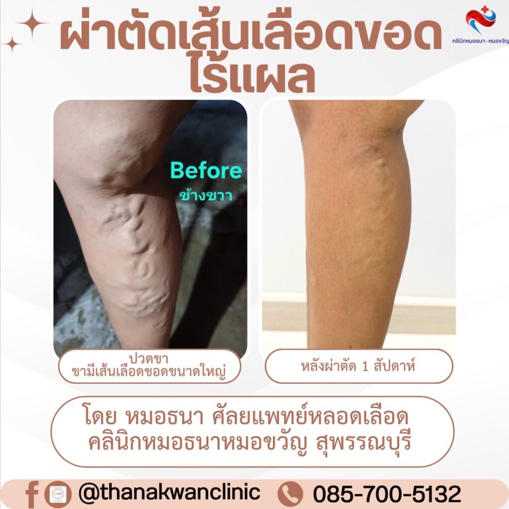 ปวดขาและมีเส้นเลือดขอดใหญ่ที่ขา