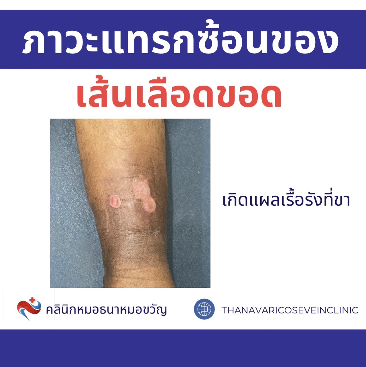 ภาวะแทรกซ้อนเส้นเลือดขอด