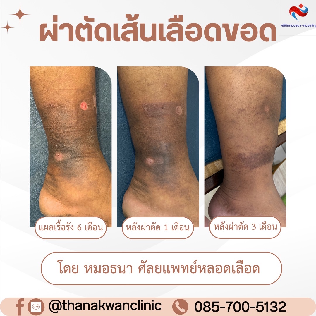 รีวิวการรักษา เส้นเลือดขอดแบบไร้แผล