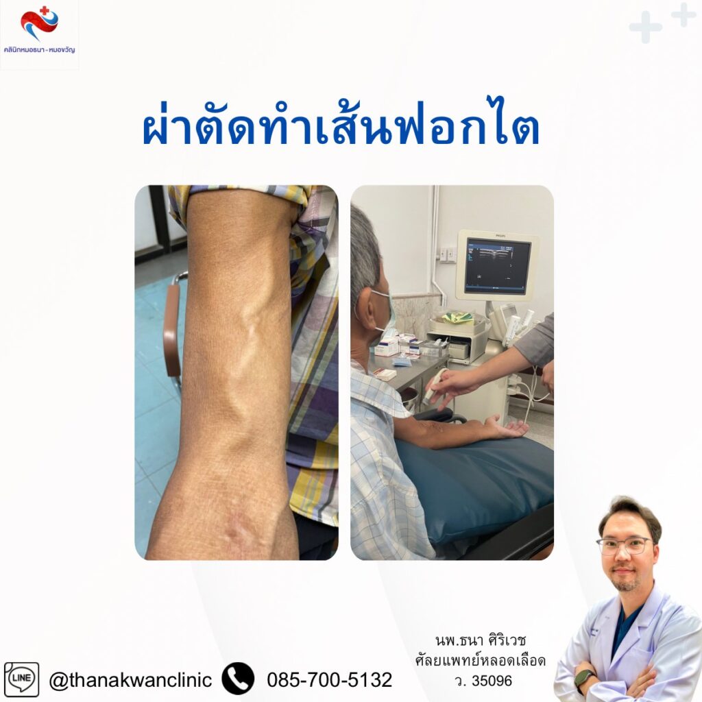 ผ่าตัดทำเส้นฟอกไต