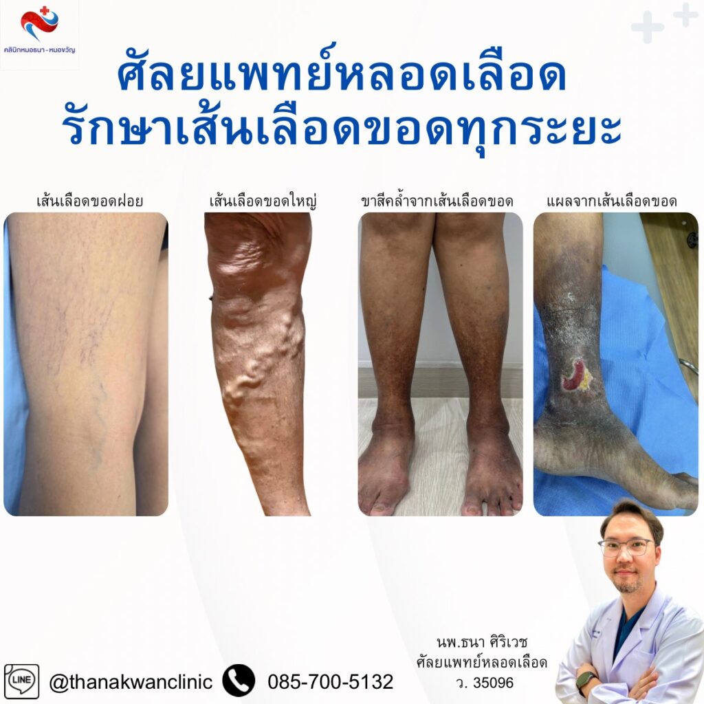 ศัลยแพทย์หลอดเลือด รักษาเส้นเลือดขอดทุกระยะ