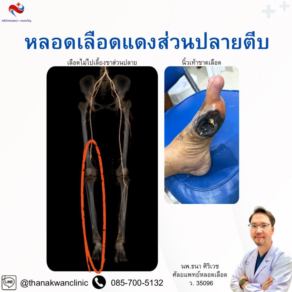 หลอดเลือดแดงส่วนปลายตีบ