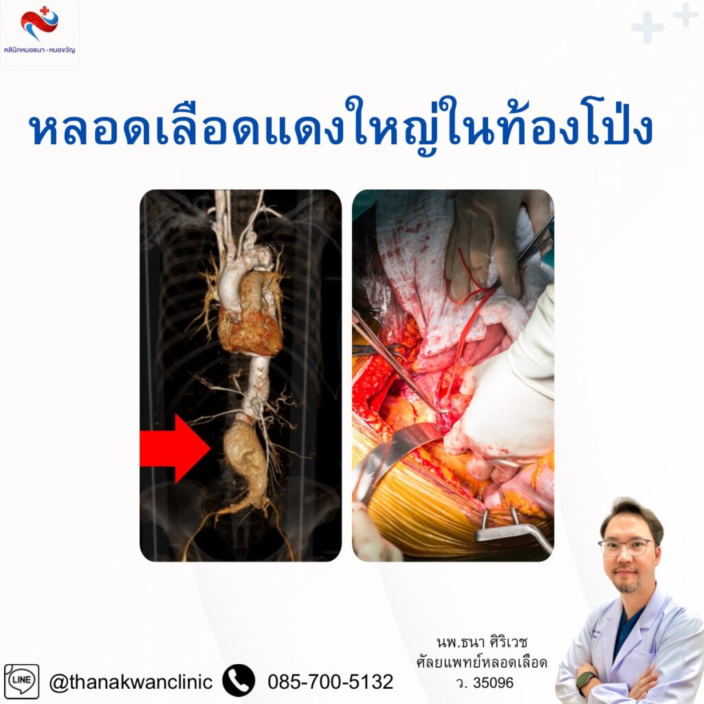 หลอดเลือดแดงใหญ่ในท้องโป่ง