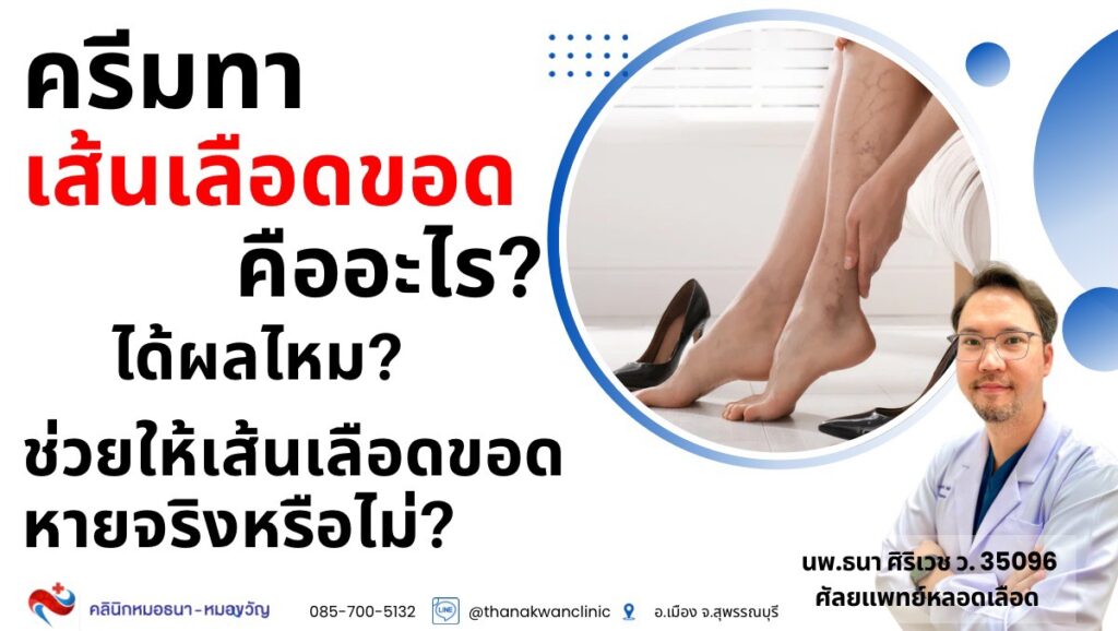 ครีมทาเส้นเลือดขอด คืออะไร เหมาะกับใคร เห็นผลจริงไหม