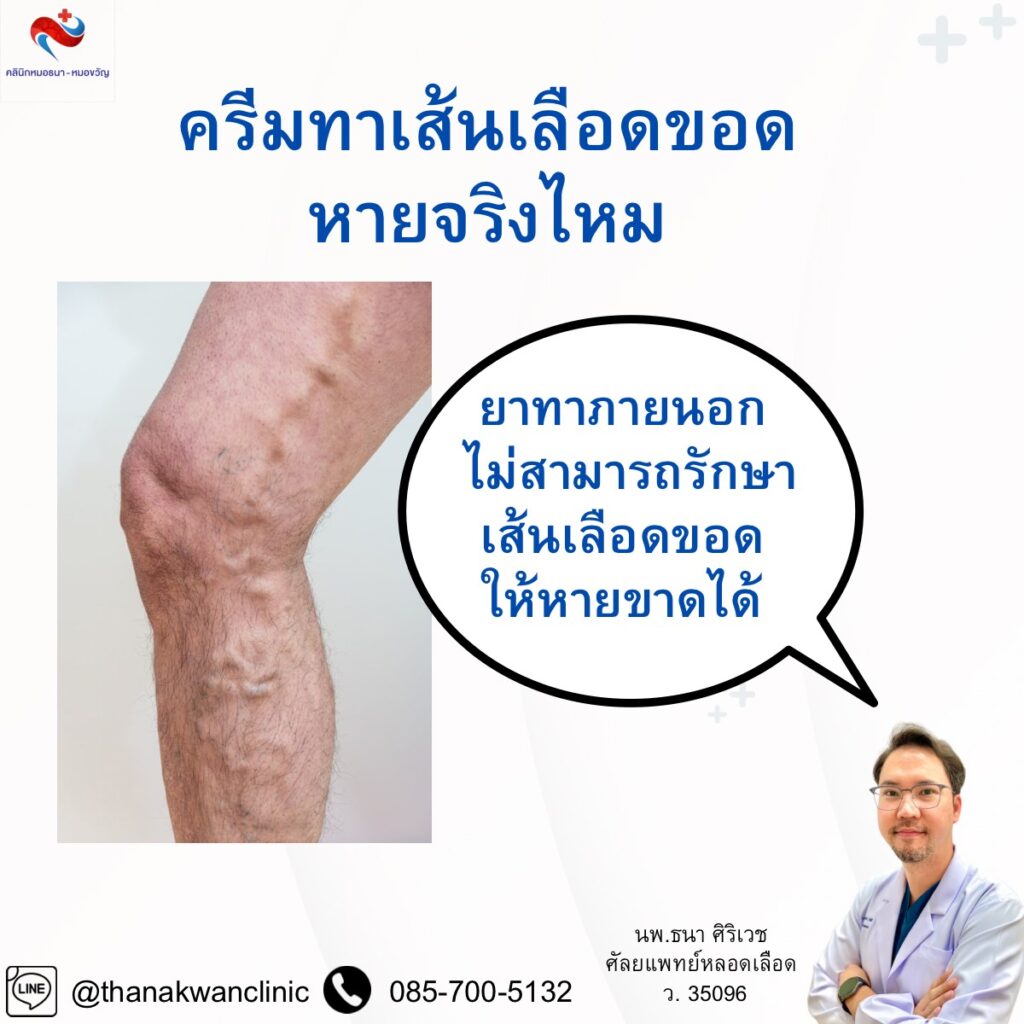 ครีมทาเส้นเลือดขอด ใช้แล้วหายจริงไหม