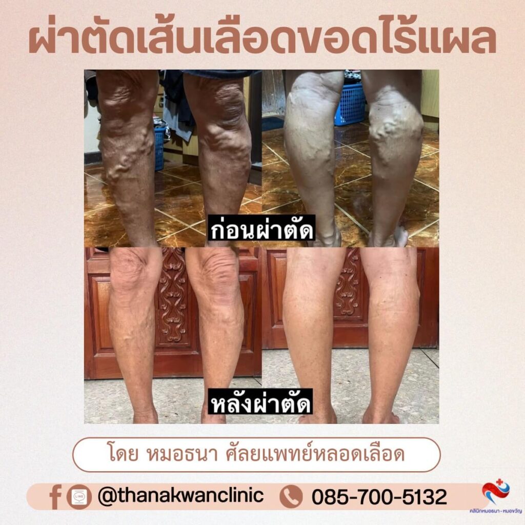 ผ่าตัดเส้นเลือดขอด โดยศัลยแพทย์หลอดเลือด